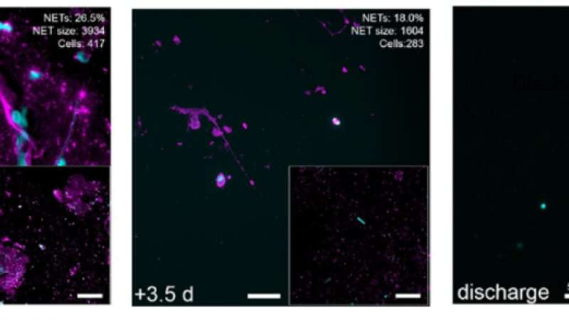 Drug dissolved net-like structures in airways of severely ill COVID-19 patients