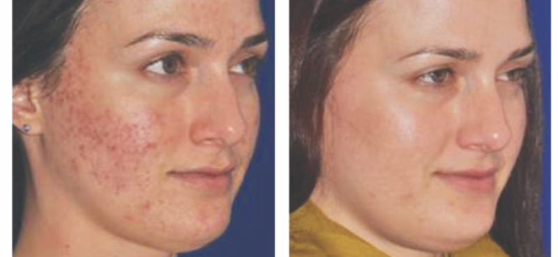 REMOVE DAMAGE FROM SUMMER SUN – FABULOUS FALL FACIAL SPECIALS