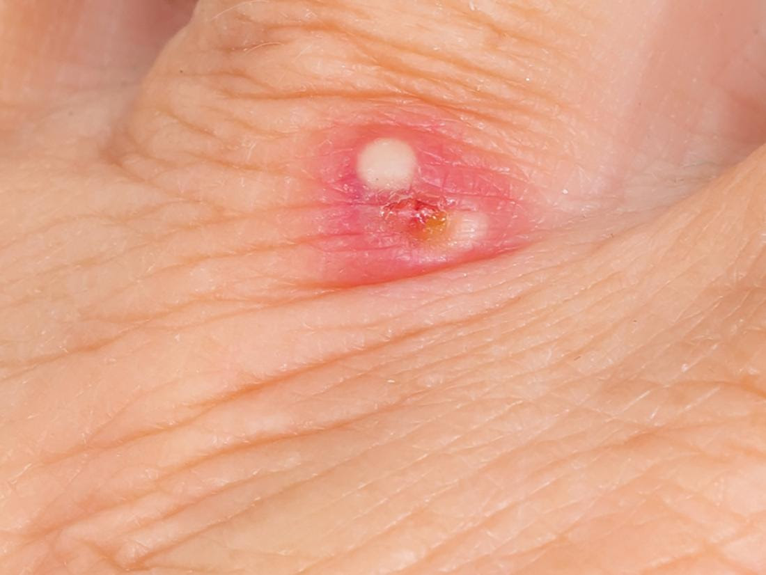 a red ant bite on the hand.