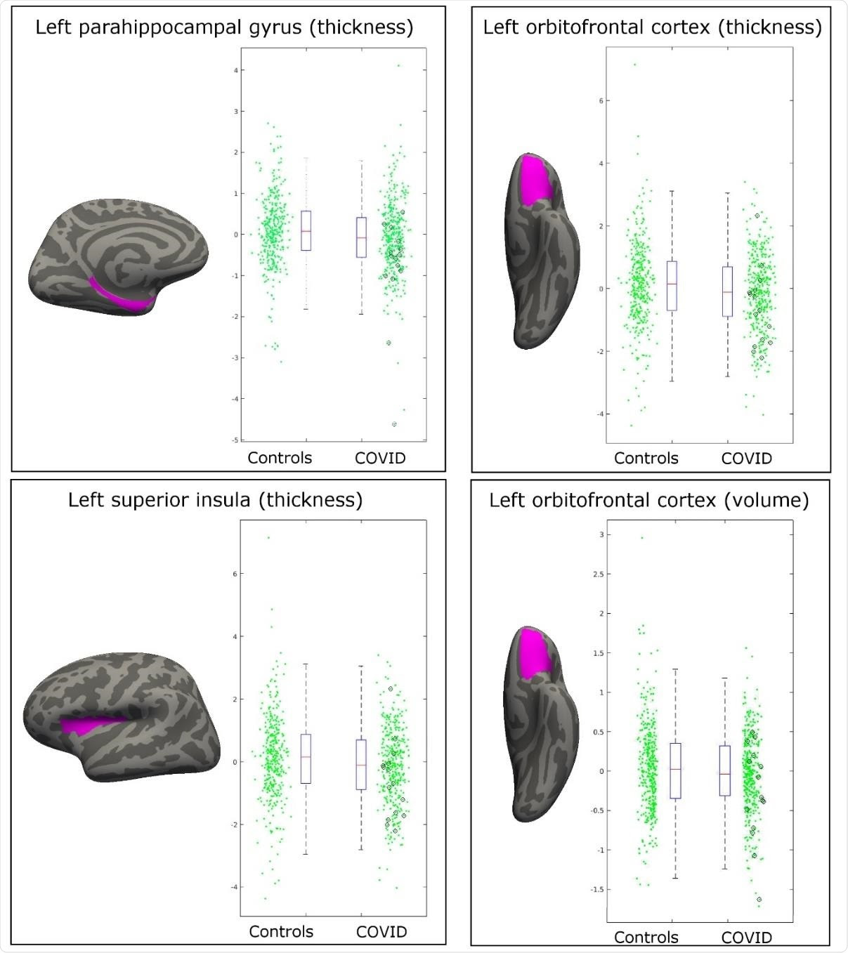 Most significant longitudinal group comparison results. The three main regions showing significant loss of grey matter (thickness, volume) between the two timepoints specifically for the COVID patients are the parahippocampal gyrus, the lateral orbitofrontal cortex, and the superior insula. All results were localised to the left hemisphere. For each region, the IDP spatial region of interest shown in magenta, overlaid on the FreeSurfer average inflated cortical surface; to the right are the scatter and box plots showing the difference in cortical thickness or volume between the two timepoints for the 388 controls and 394 COVID patients. In black circles are the 15 hospitalised COVID patients. All y axes are arbitrary units proportional to the original measures, due to the normalisation steps in the IDP preprocessing.