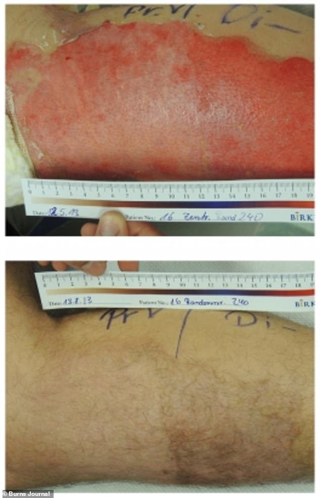 After three months (pictured bottom) and 12 months, the appearance of the birch-bark treated skin (left) was more like that of healthy skin in its texture and pigmentation compared to the standard gel treated skin (right)