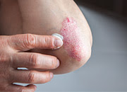 A red rash on a person's elbow
