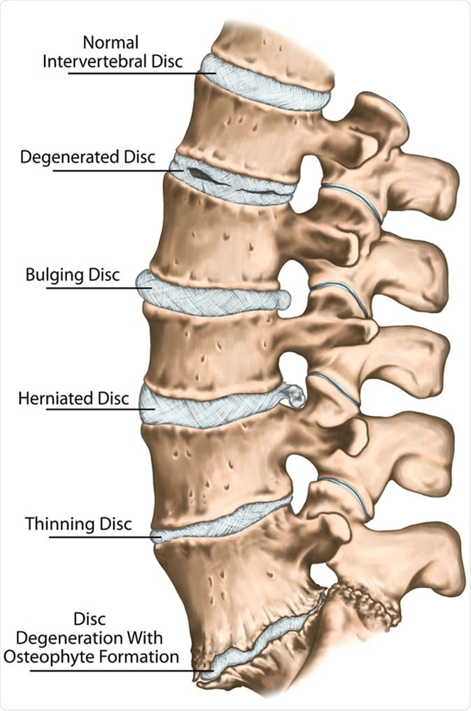xray lumbar spine bulging disk