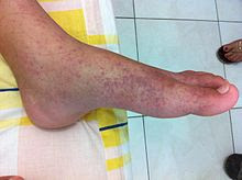 2012-01-09 Chikungunya on the left feet at The Philippines.jpeg