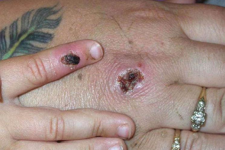 One patient in New York City tested positive for Orthopoxvirus, a diease related to monkeypox, according to the health department.