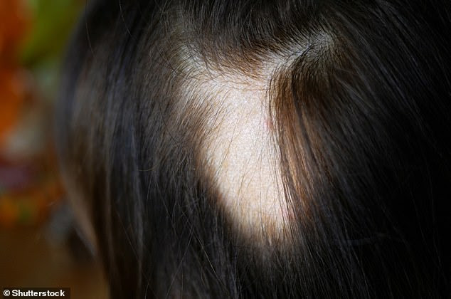 Alopecia areata develops when the body attacks its own hair follicles (where hair grows from), which can cause hair loss anywhere on the body (stock image)