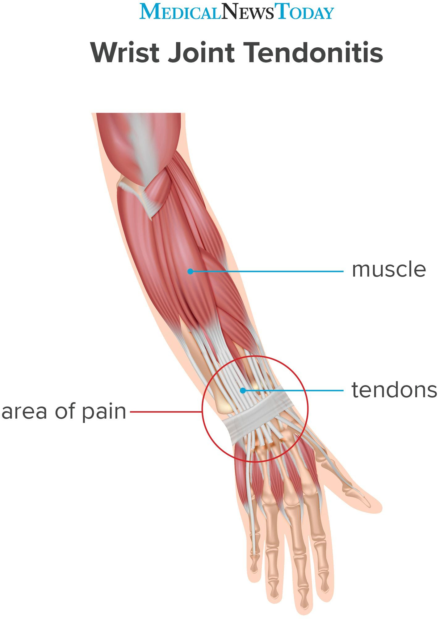 an infographic for Tendonitis of wrist