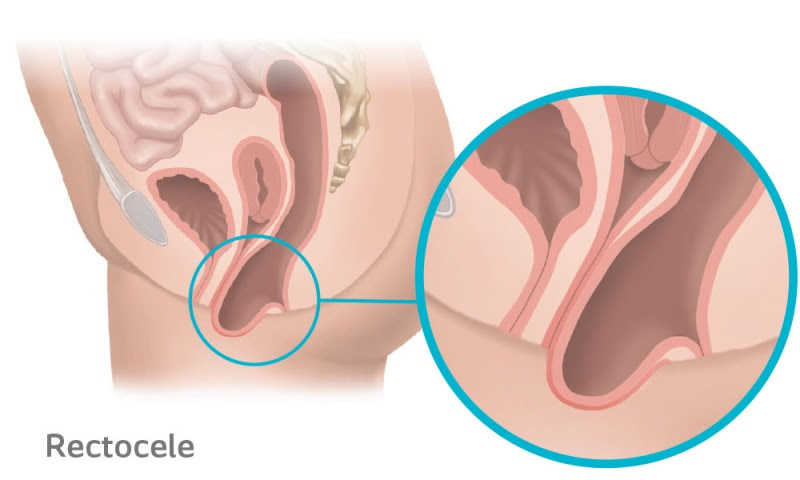 Rectocele Prolapse occurs when the rectum protrudes into the vagina due to the weakening of the supporting tissue.