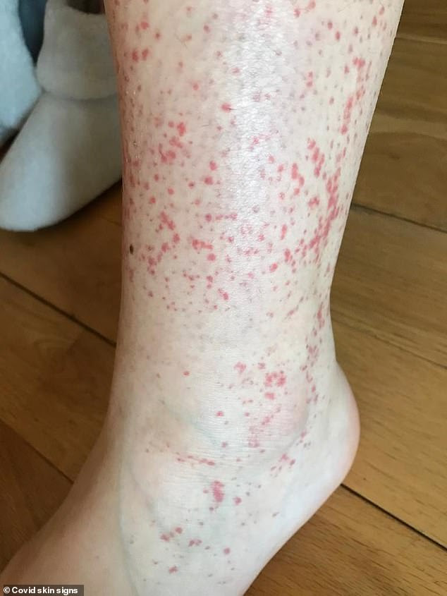 covid rash on foot