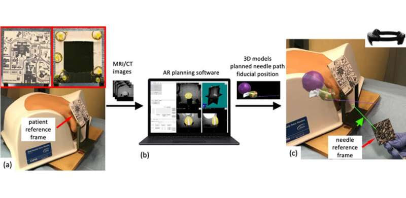 Free-hand, real-time needle guidance for prostate cancer diagnosis with augmented reality