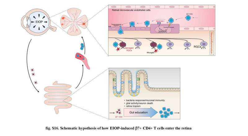 Association found between gut immune cells and eye damage from glaucoma