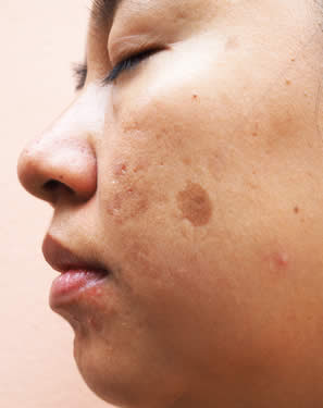 melasma