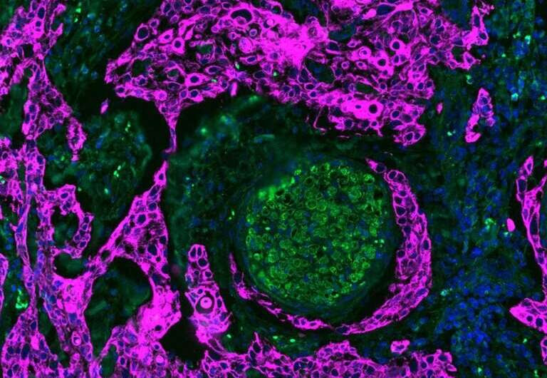 Researchers look at space between nerves and tumor cells to identify most aggressive oral cancers