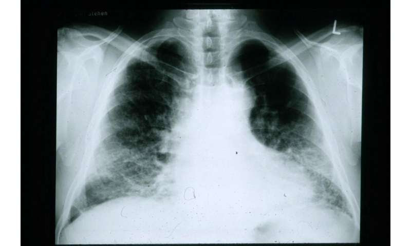 Idiopathic pulmonary fibrosis