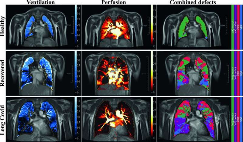 Lasting lung damage seen in children and teens after COVID