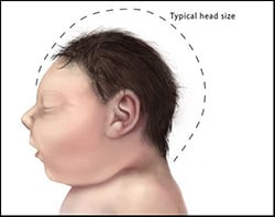 The figure above is a CDC drawing showing an infant with microcephaly.