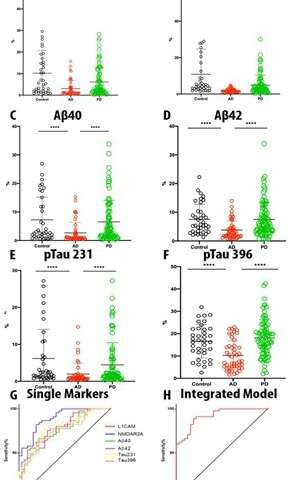 Scientists diagnose Alzheimer's disease by blood test