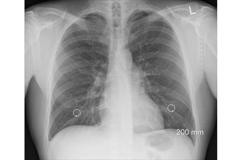 chest xray