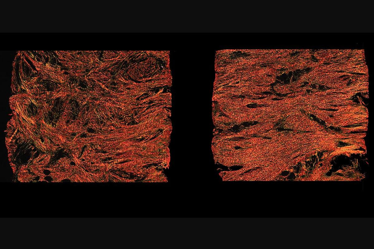 Microscope images of the enmeshed collagen fibers in a scar treated with alphaCT1 (left) and the less flexible aligned fibers in a scar treated with a non-medicated gel (right)