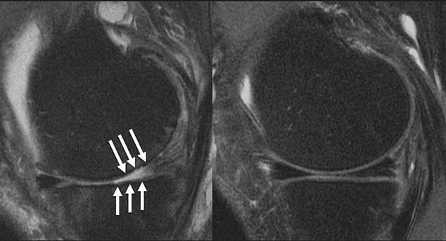 The above shows the knee joint of a patient with arthritis (left), with the arrows indicating where cartilage has been worn away. The other (right) shows a patient who does not have arthritis