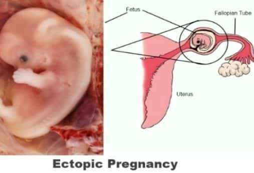 Medical intervention to resolve the ectopic pregnancy ethical dilemma. When should jeopardize the life of the fetus to preserve the mother's life?