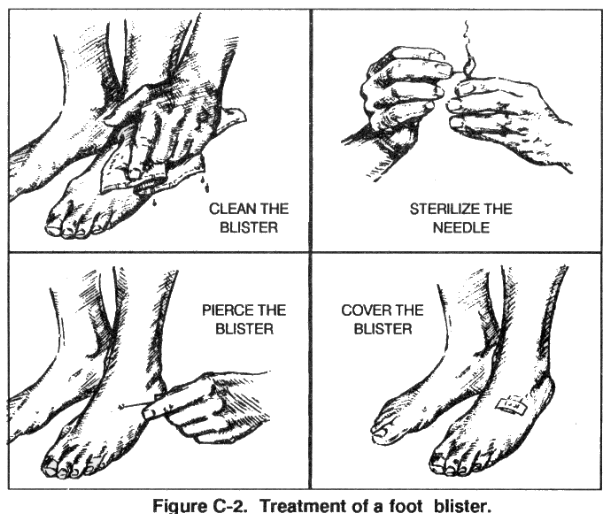 how to clean pop treat blister vintage illustration diagram