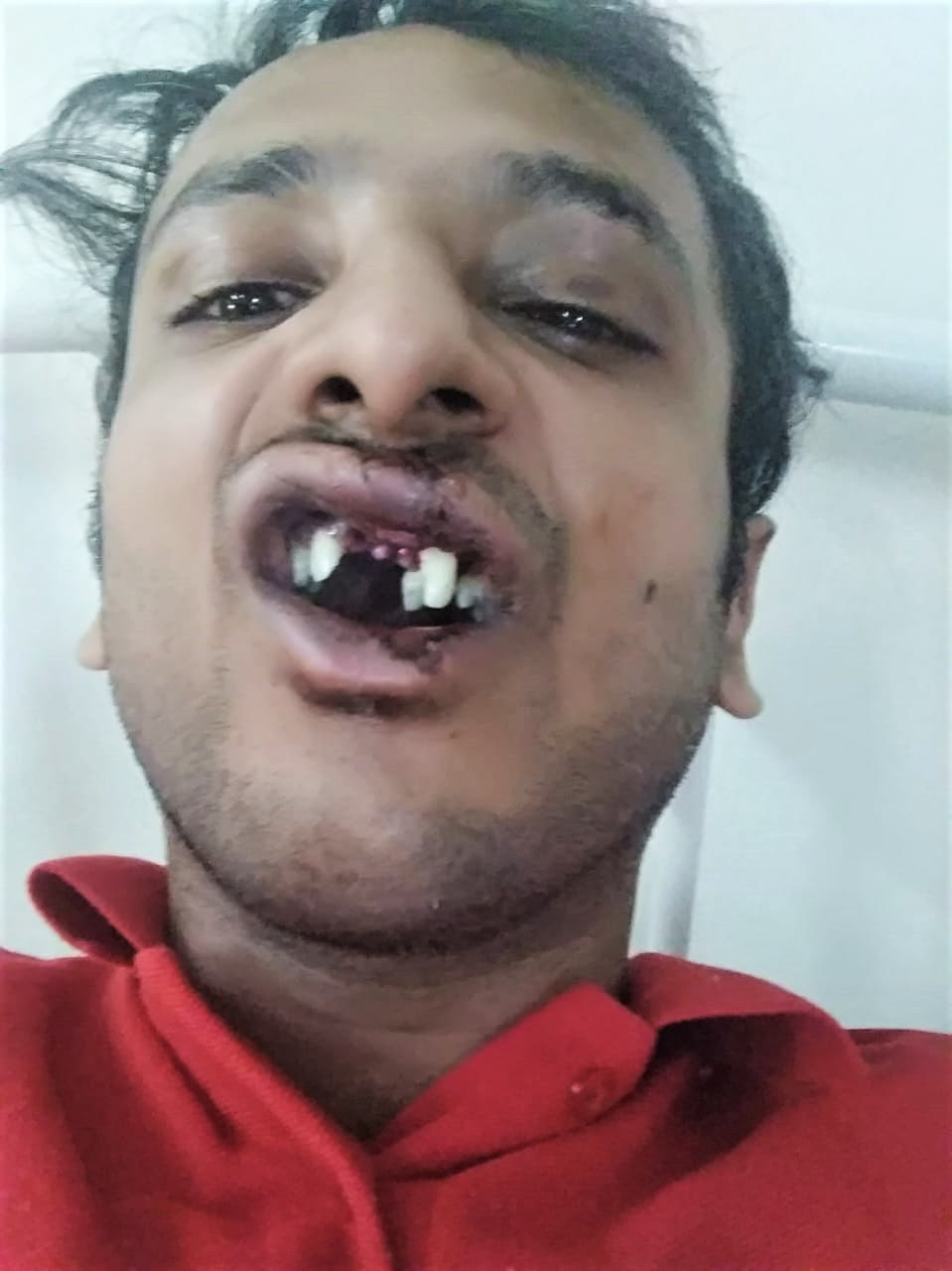  Abhishek Mangala lost teeth in assault by Hindu extremists in Sohna, Haryana state, India on Sept. 22, 2019. (Morning Star News)